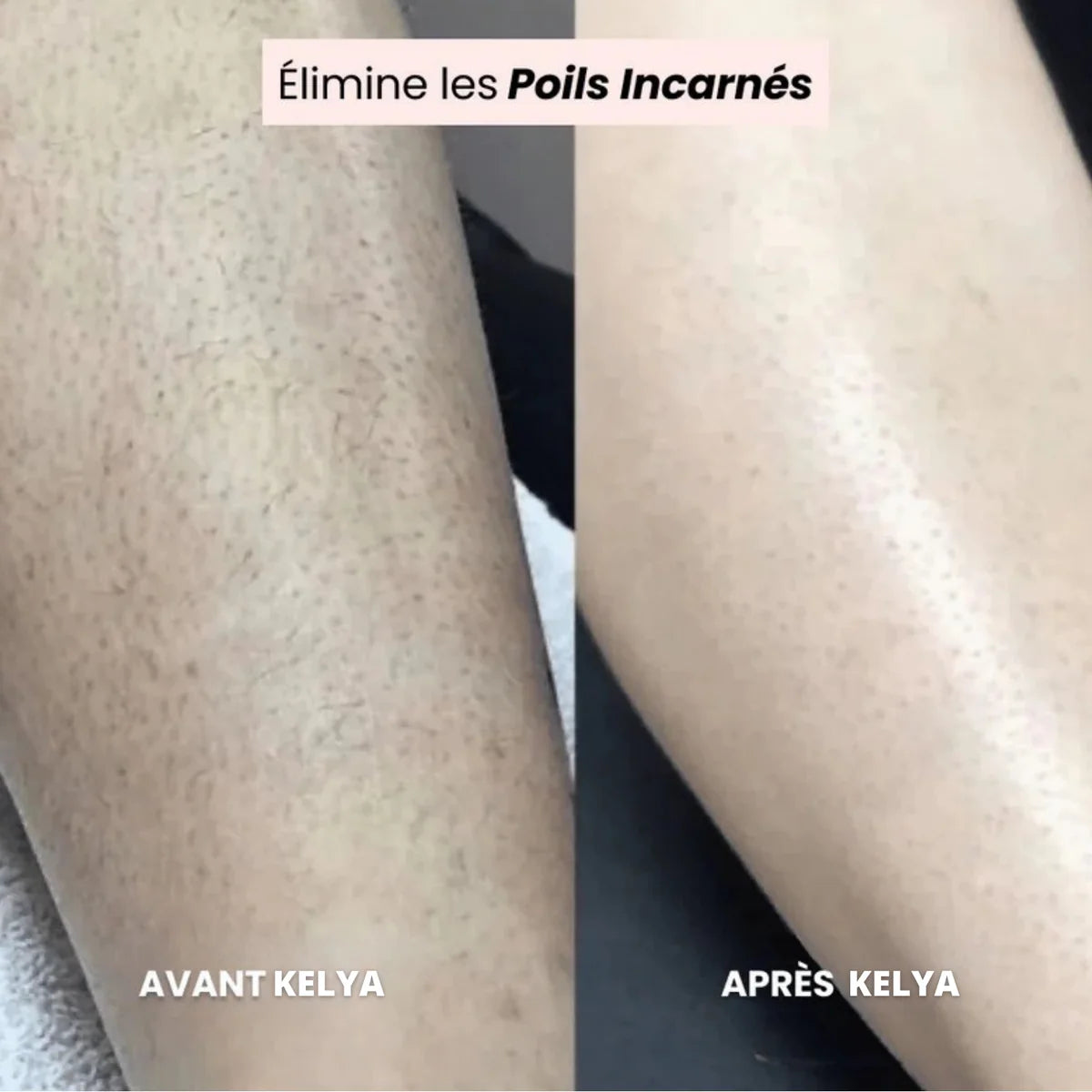 La solution douce pour toutes les zones sensibles