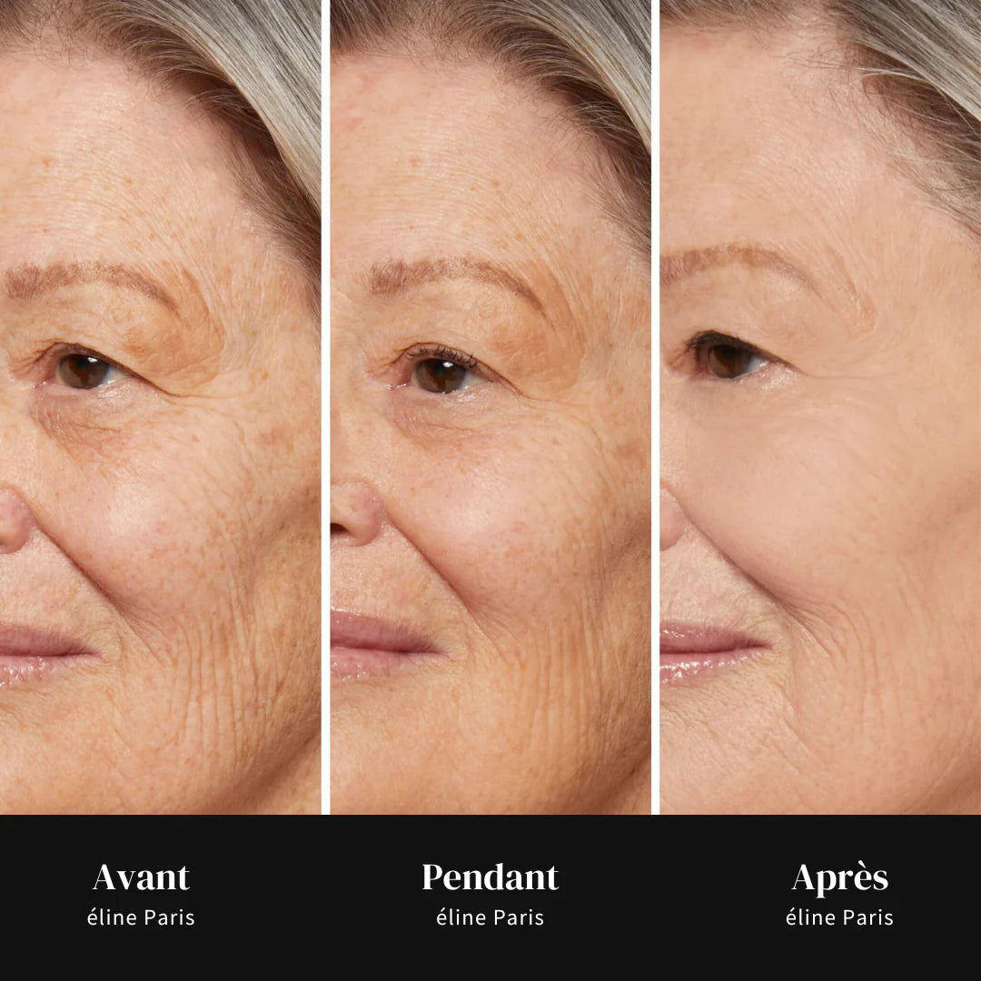Elyane™ - Lisseur de Rides