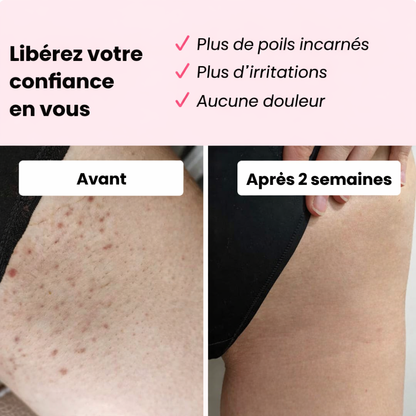 Épilateur Élyane™ IPL  Appareil d’épilation à lumière pulsée